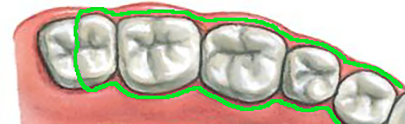 3rd molar
